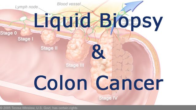 Using liquid biopsy to monitor colorectal cancer