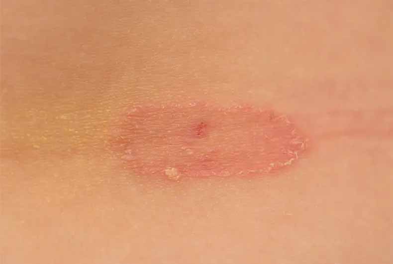 Fear of unusual Monkeypox outbreak looms in Australia