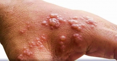Monkeypox: Fear pushing people to dermatologists to check for symptoms