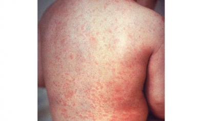 Four children die of Measles-Rubella in Jharkhand’s Dhanbad